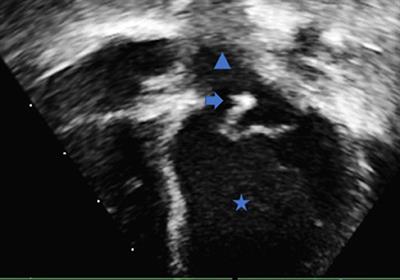 Infective Endocarditis, a Rare Complication of Late Neonatal Group B Strep Sepsis